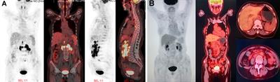 Successful Outcome of Programmed Death 1 Blockade Plus GemOx for Epstein-Barr Virus-Associated Primary Nodal T/NK Cell Lymphoma: A Case Report